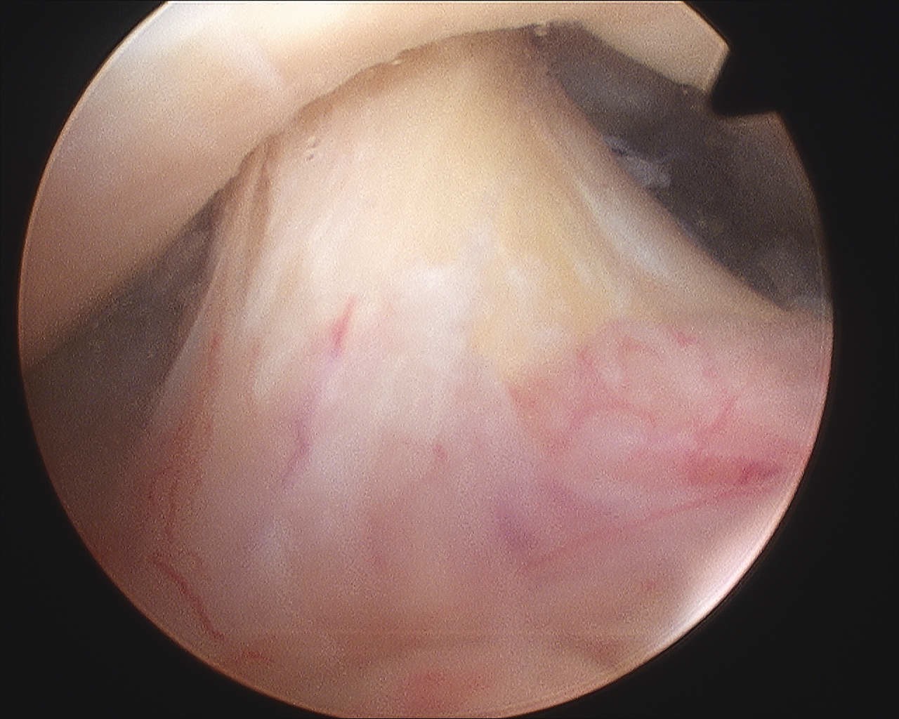 ACL Normal Arthroscopy